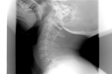 Latigazo cervical: Antes y después del nuevo baremo