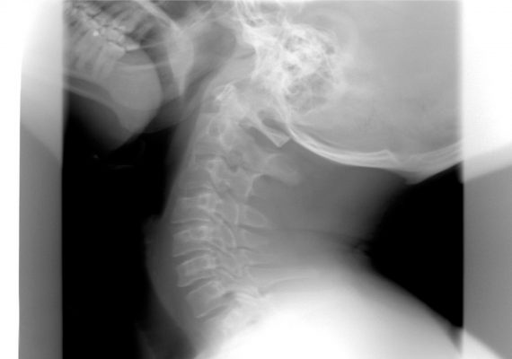 Latigazo cervical: Antes y después del nuevo baremo